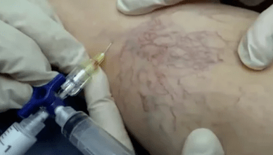 skleroterapija venų varikozei gydyti