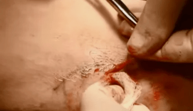 venų varikozės šalinimo operacijų rūšys